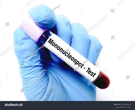 monospot blood test bottle|how to test for mononucleosis.